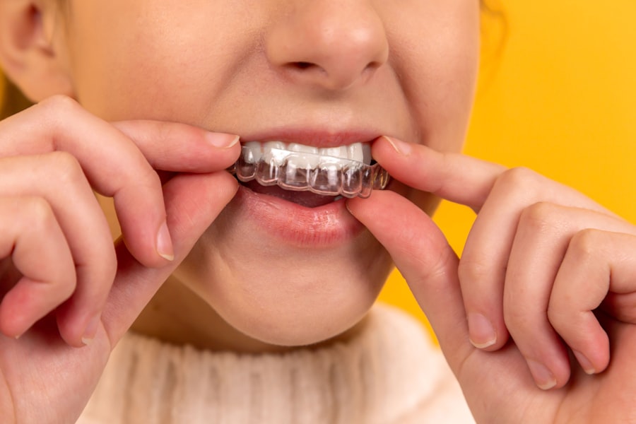 Alinhador transparente sendo colocado nos dentes