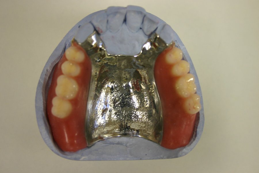 Prótese parcial removível sobre modelo odontológico